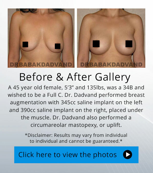 Breast lift (Mastopexy). Before and After Photos.