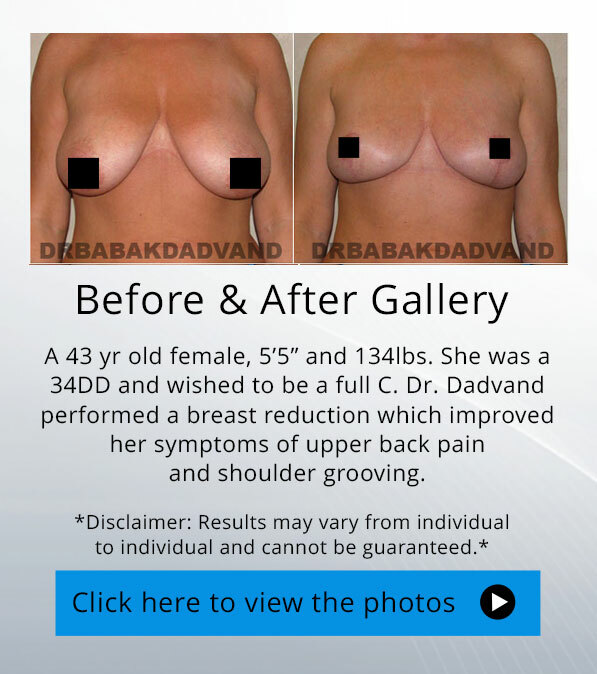 Breast Reduction. Before and After Photos.